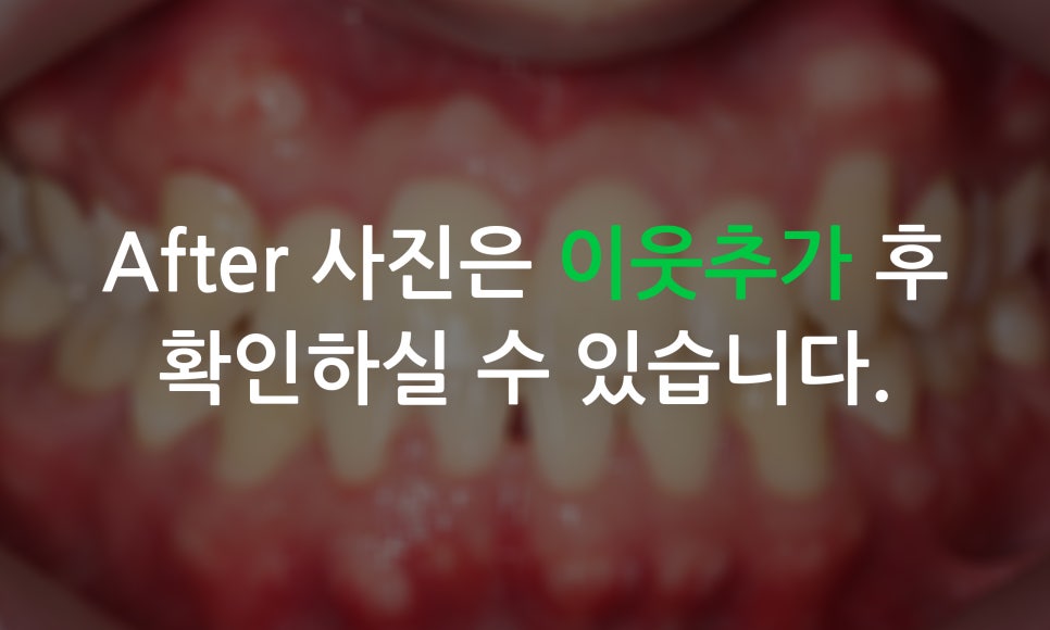 송곳니덧니가 있을 때 교정하는 방법! 관련 이미지 5