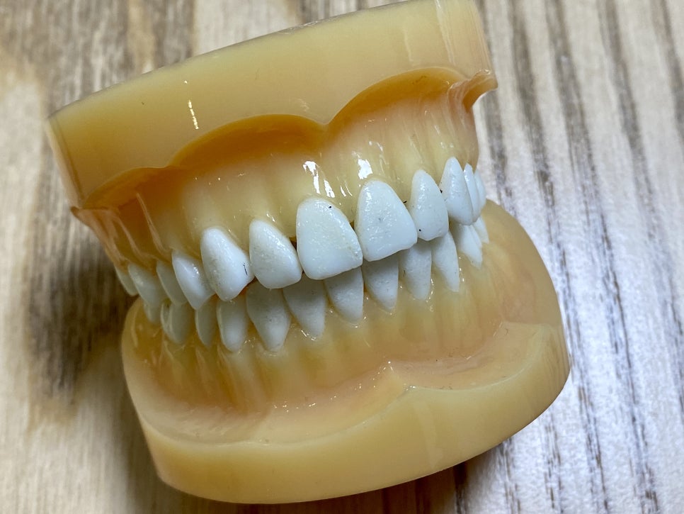 부분교정으로 삐뚤어진 앞니 예뻐지는 방법 관련 이미지 2