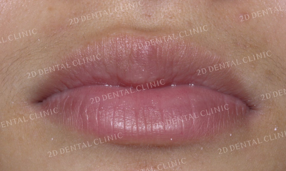 반대교합 치아교정, 앞니를 가지런하게! by.투디치과(2D치과) 관련 이미지 2