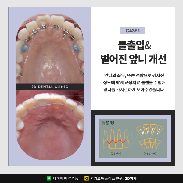 앞니치아교정, 2D교정은 관련 이미지 5