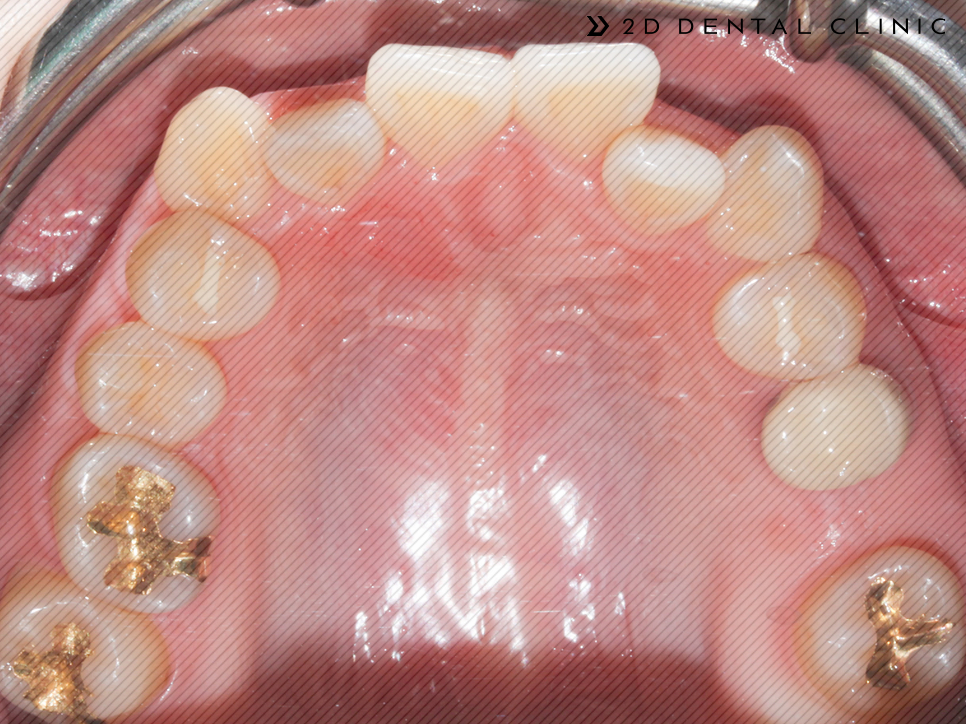 발치교정 돌출입 케이스, 교정전문 2D치과 관련 이미지 9