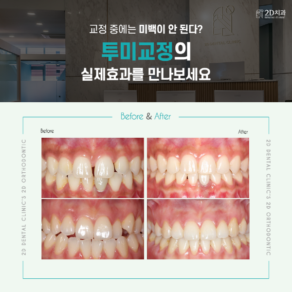 치아교정에 미백을 더하면? 2D치과 <투미교정> 관련 이미지 2
