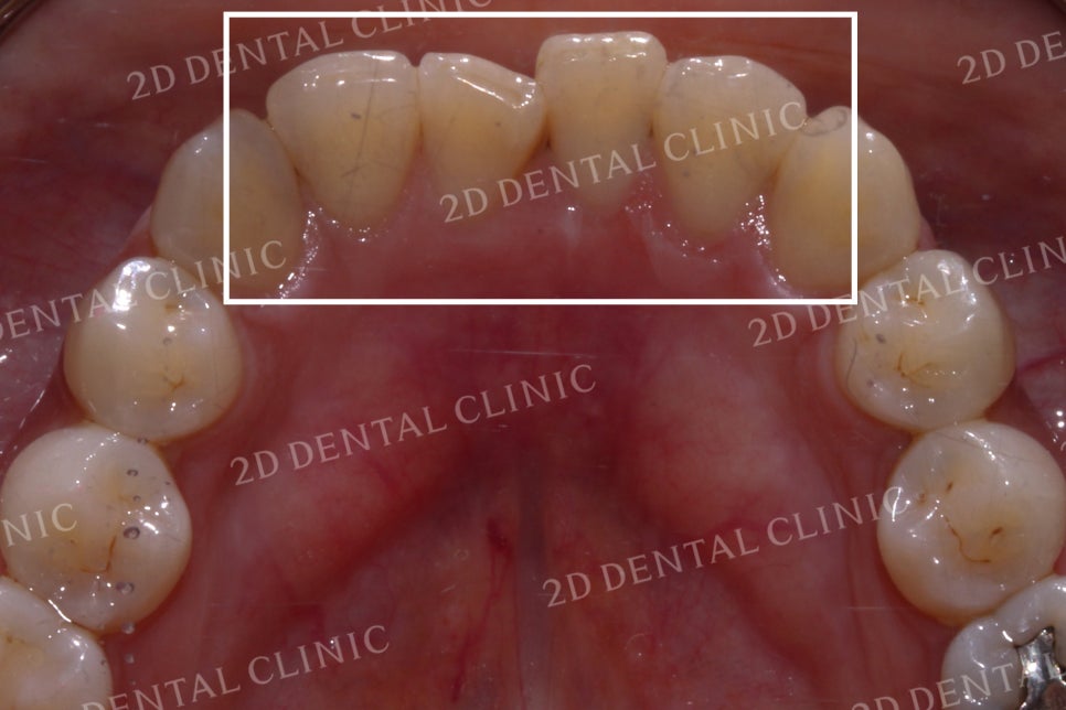 반대교합으로 물리는 치아를 바른 교합으로 교정하기! by.투디치과(2D치과) 관련 이미지 6