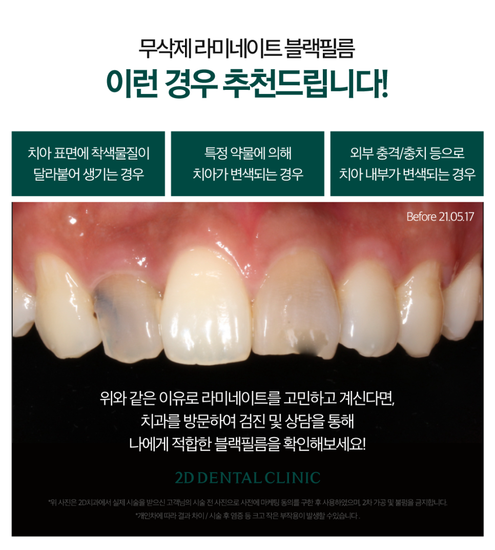 대전무삭제라미네이트 치아부분변색 전후 차이와 비용까지! 관련 이미지 3