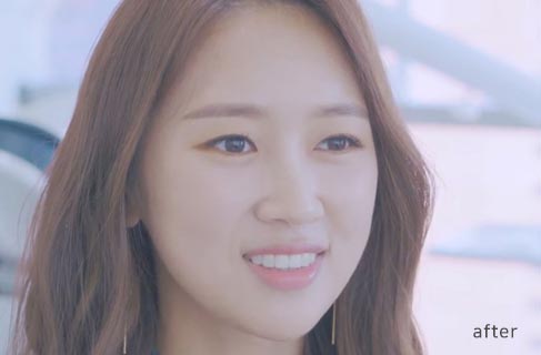 투디치과(2D치과)에서 직!접! 무삭제 쎄라필름을 한 리얼후기 관련 이미지 10