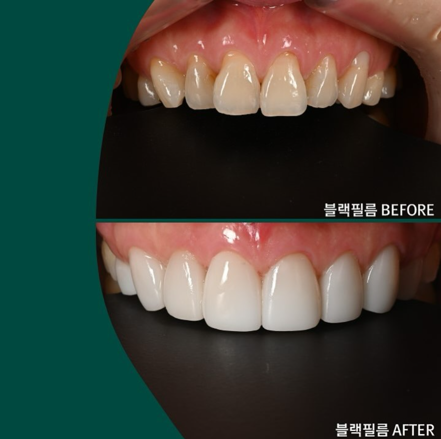 라미네이트 뜻 무삭제 라미네이트 블랙필름은 어떤 시술? 관련 이미지 2