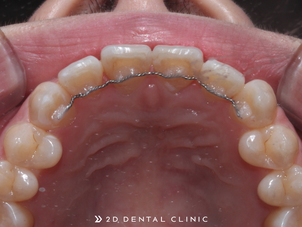 나비치아, 앞니 부분 2D교정으로 교정 기간 단축! 관련 이미지 11