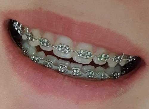 강남라미네이트 무삭제 치아성형 블랙필름 관련 이미지 4