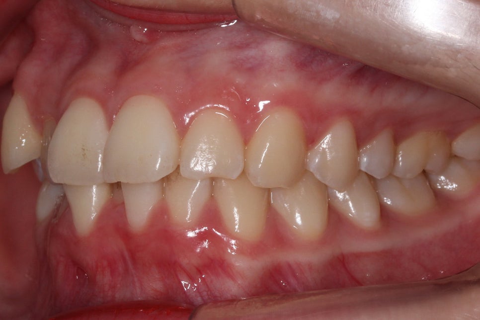 투디치과 송곳니덧니 치료 후기 관련 이미지 5