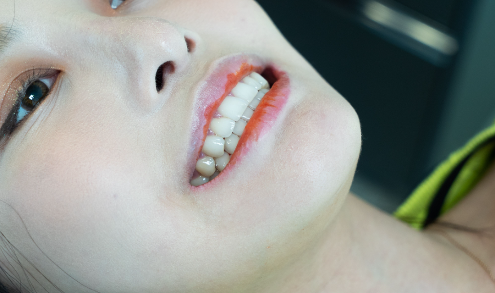 무삭제 라미네이트 교정 고민중이라면? 관련 이미지 3