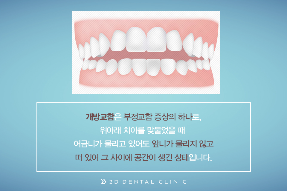 개방교합, 교정으로 잇몸질환 예방하자! 관련 이미지 3