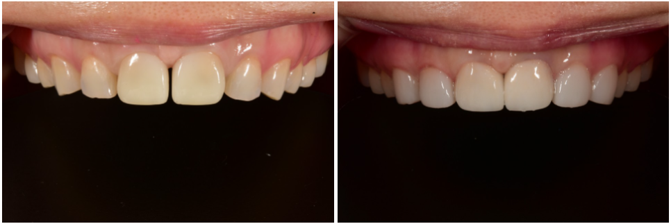 앞니라미네이트 잘하는 곳 : 2D치과 관련 이미지 4