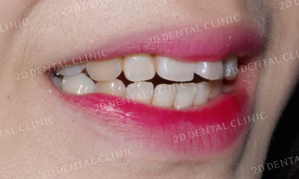 [앞니교정] 부정교합 교정, 앞니교정으로 부정교합 교정하는 방법! by. 투디치과(2D치과) 관련 이미지 11