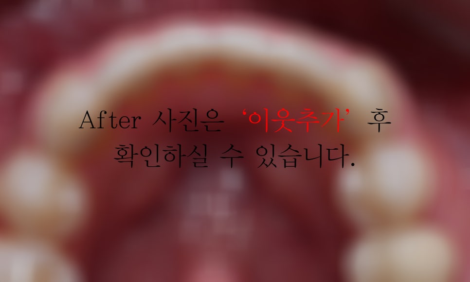 아랫니 부분교정 2D교정(설측교정)으로 가능할까? 관련 이미지 5