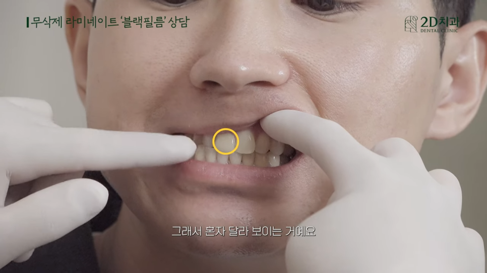 [블랙필름 상담 받고 왔어요] #4 크라운 위에 블랙필름 가능한가요? 관련 이미지 17