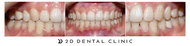 과개교합 케이스도 2D치과에서 해결! 관련 이미지 6