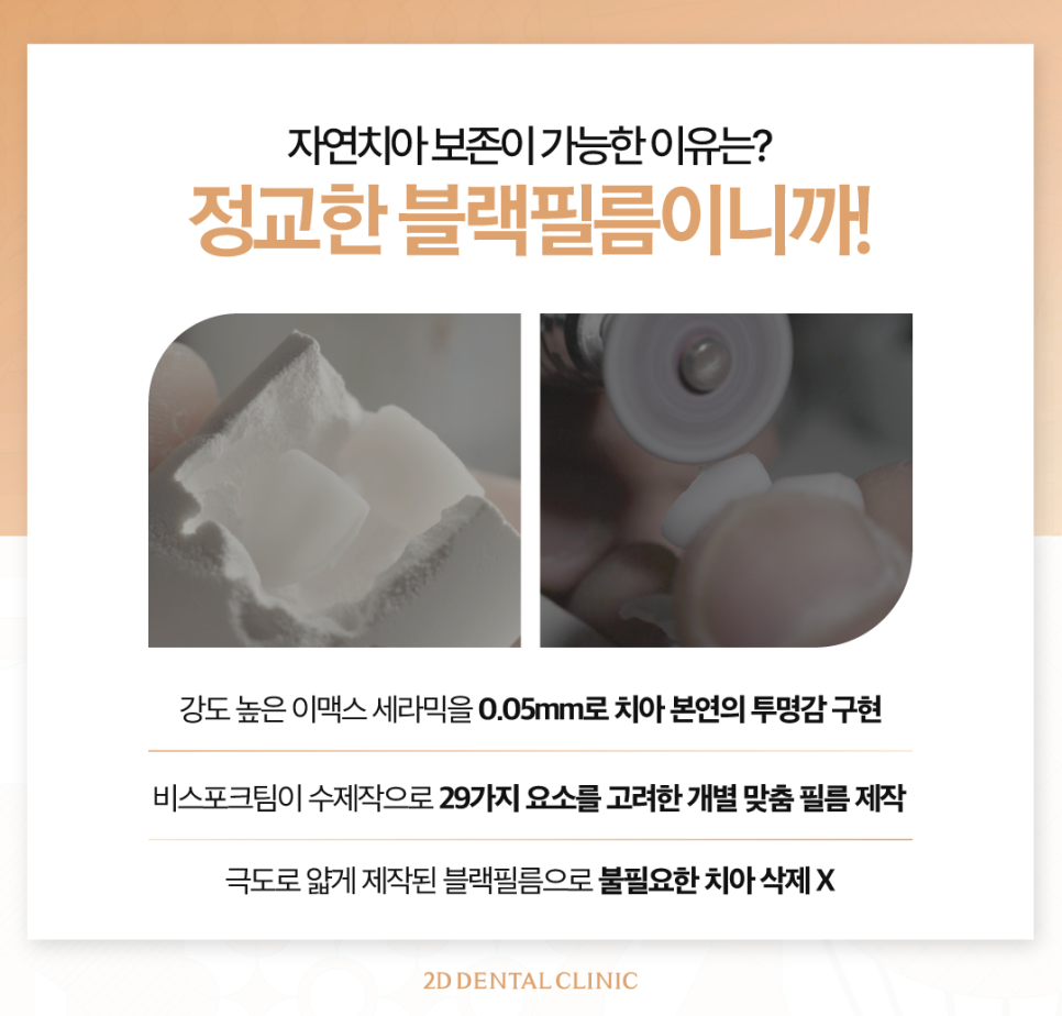 광주무삭제라미네이트 치아미백효과 자연스러움을 찾는 분들 주목 관련 이미지 5