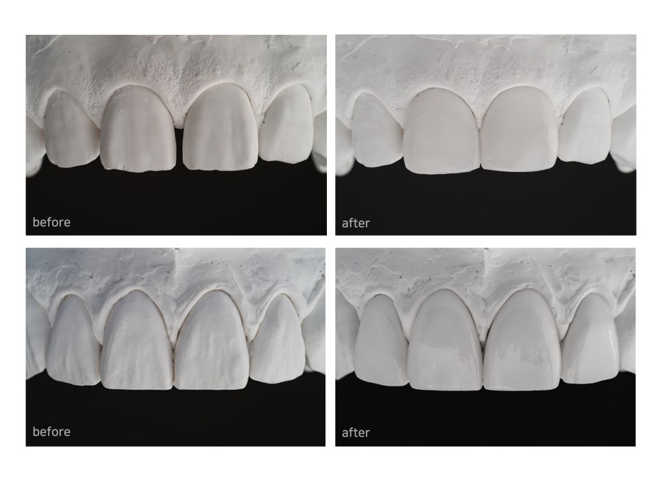 앞니깨짐, 치아미백엔 무삭제 "쎄라필름(TheraFilm)" 관련 이미지 5