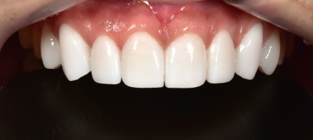 블랙트라이앵글 치아사이틈 개선은 무삭제라미네이트 블랙필름 관련 이미지 5