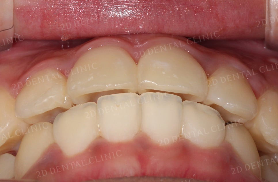 [앞니교정] 토끼앞니교정, 클리피씨 교정으로 완벽하게! by.투디치과(2D치과) 관련 이미지 11