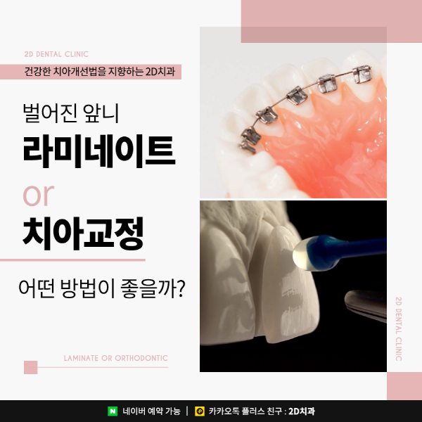 벌어진앞니는 라미네이트? 치아교정? 이렇게 선택하세요 관련 이미지 1