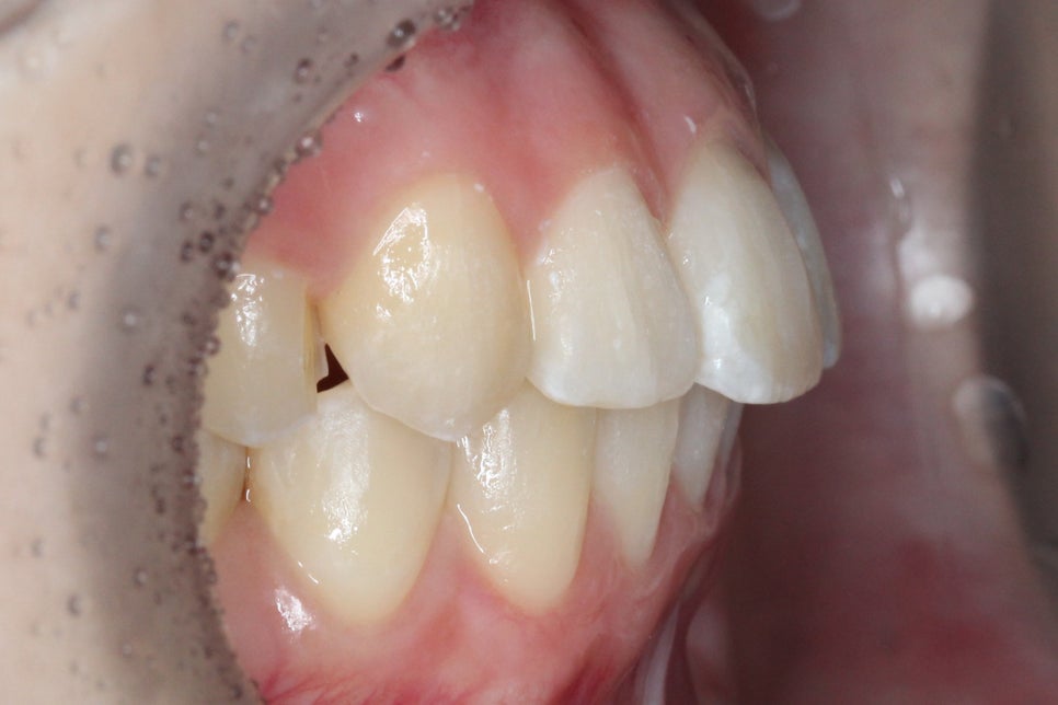 투디치과 송곳니덧니 치료 후기 관련 이미지 10