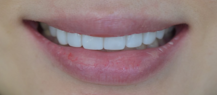 앞니 무삭제라미네이트 고객맞춤형 치아제작하는 블랙필름 관련 이미지 8