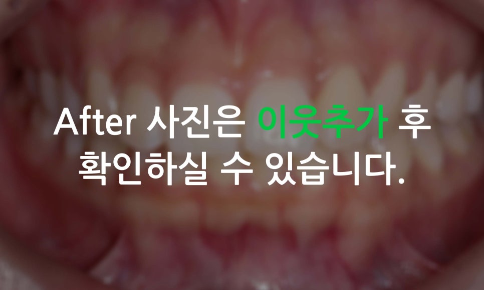 앞니틀어짐, 삐뚤어진 앞니를 부분교정하는 방법 관련 이미지 7