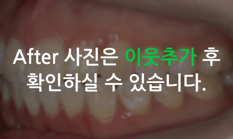 앞니돌출 급속교정 Case feat. 2D교정 관련 이미지 11