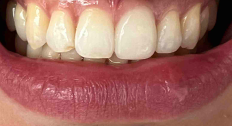 무삭제라미네이트 블랙필름의 장점과 사후관리 관련 이미지 10