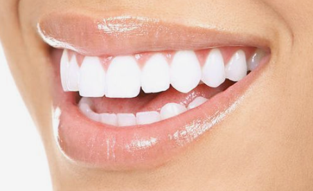 강남라미네이트 무삭제 치아성형 블랙필름 관련 이미지 3