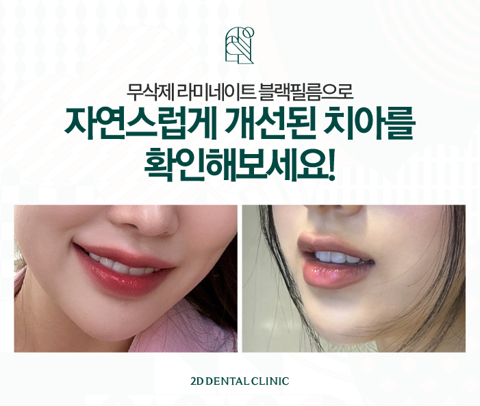 라미네이트무삭제 치아깨짐에도 자연스럽게 관련 이미지 6