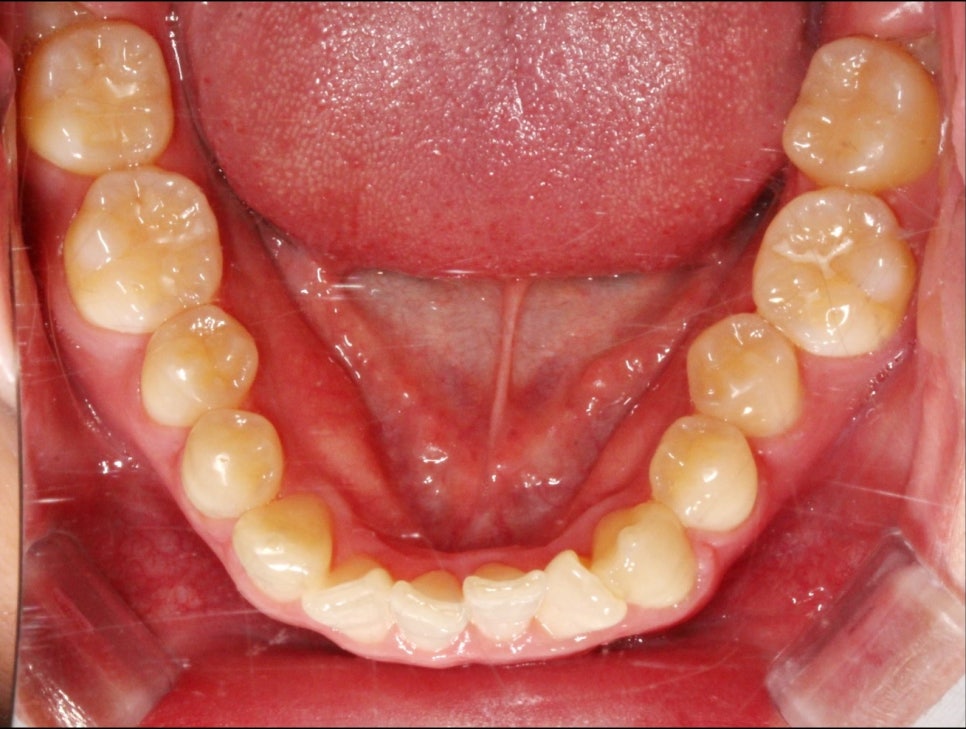 부분교정으로 삐뚤어진 앞니 예뻐지는 방법 관련 이미지 8