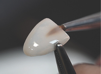 라미네이트 치료 전 체크해야할 부분은? 관련 이미지 8