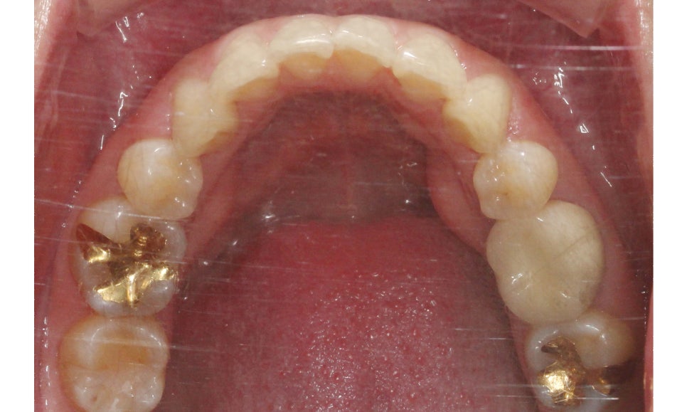 대치동치과 입툭튀 집어넣는 교정 관련 이미지 7