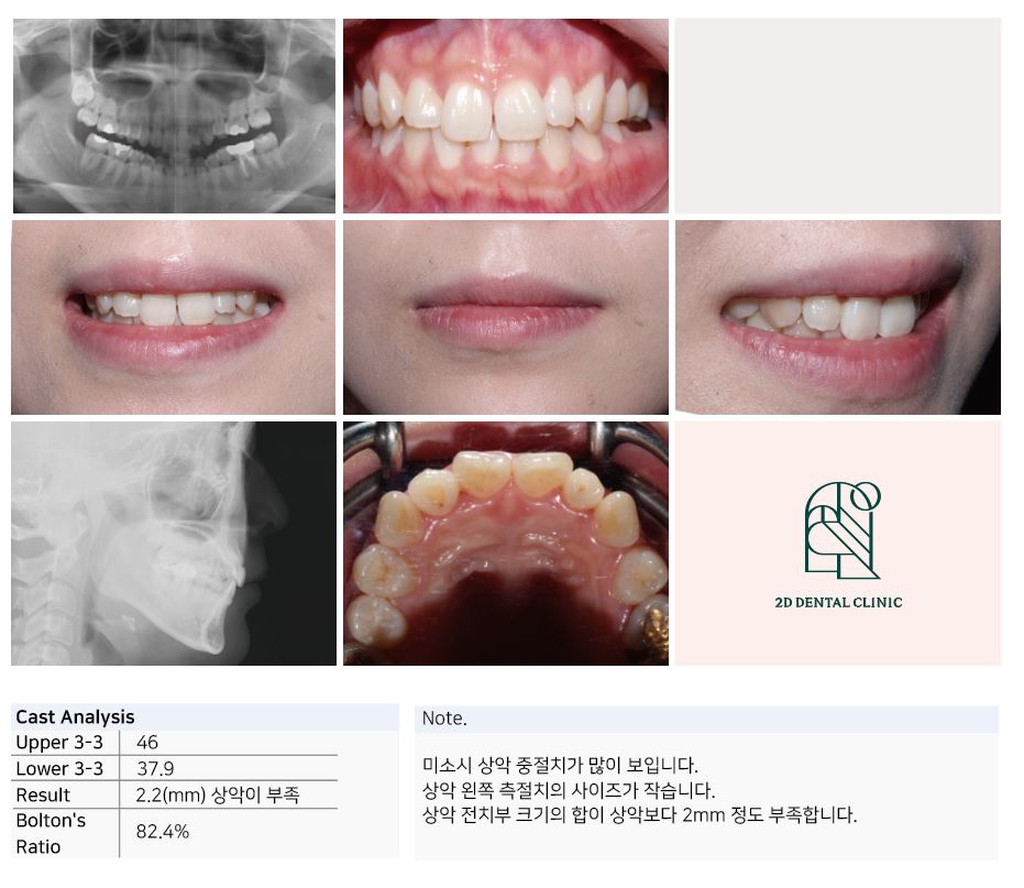 우디의 교정일기ㅣ토끼이빨 치아교정(ft.클리피씨 전체교정) 관련 이미지 4