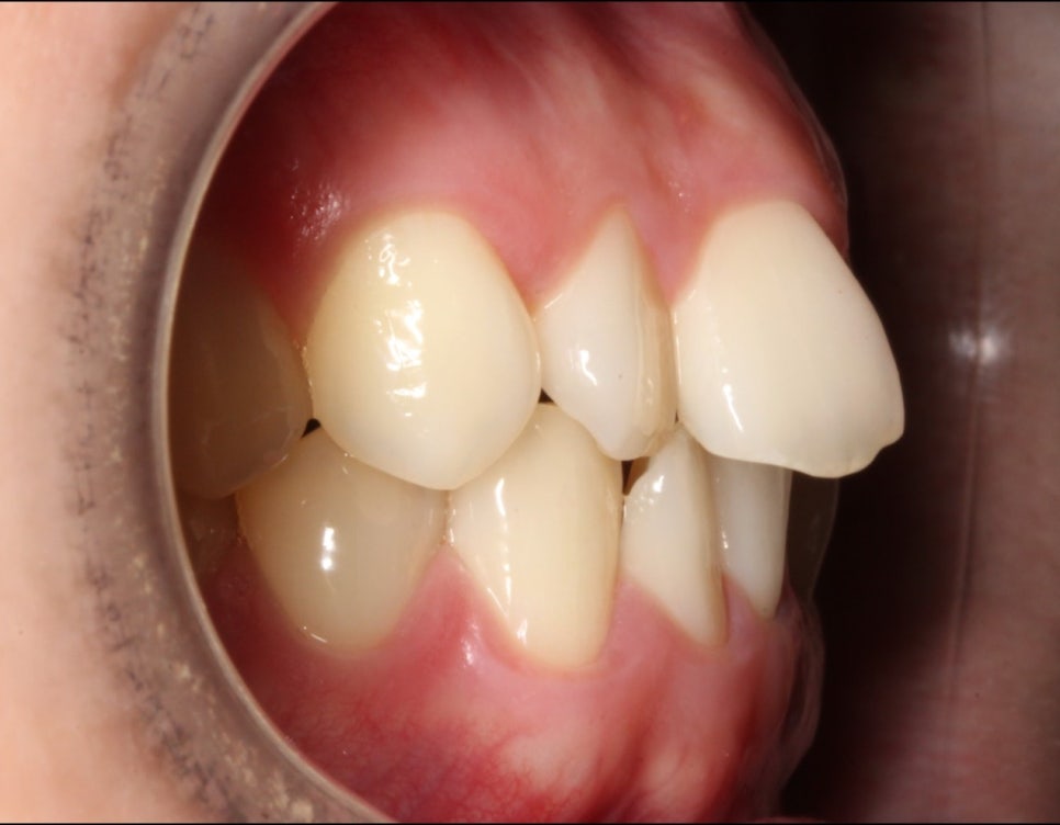 부분교정으로 삐뚤어진 앞니 예뻐지는 방법 관련 이미지 6