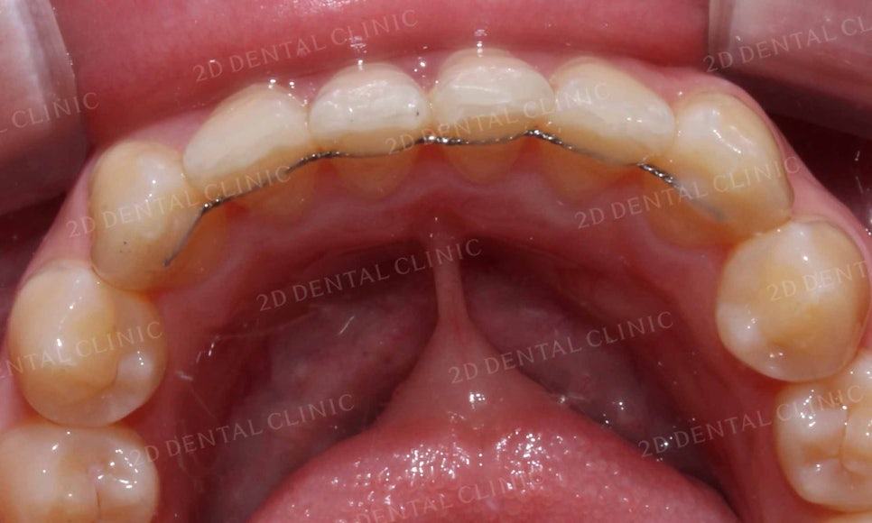강남역 치과에서 앞니부분 설측 2D(투디)교정으로 토끼앞니 탈출한 후기 관련 이미지 19