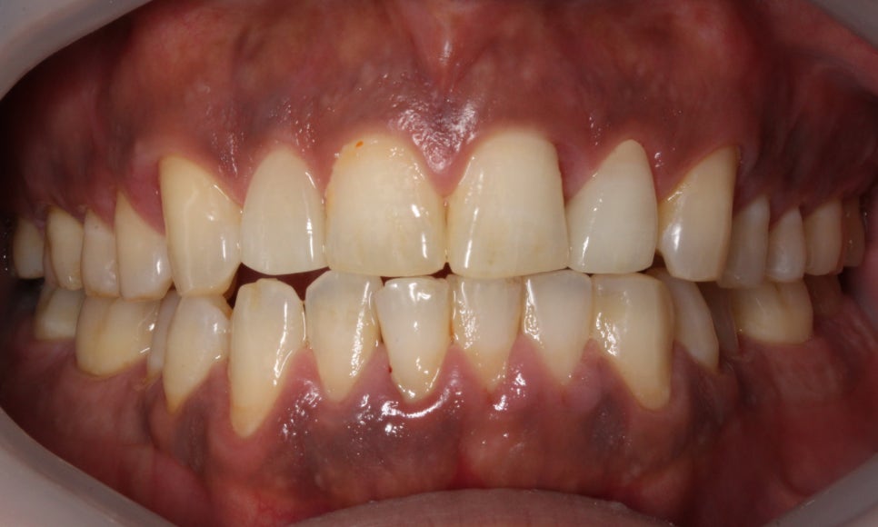 2D(투디)치과 블링스, 추천합니다!(깨진 앞니, 돌출앞니, 벌어진 앞니, 치아 노후, 치아 변색) 관련 이미지 7