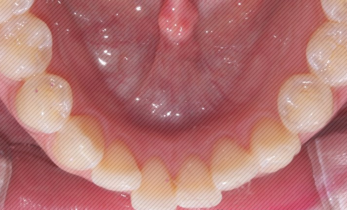 [신논현역치과] 앞니돌출 2D교정으로 개선! 관련 이미지 9