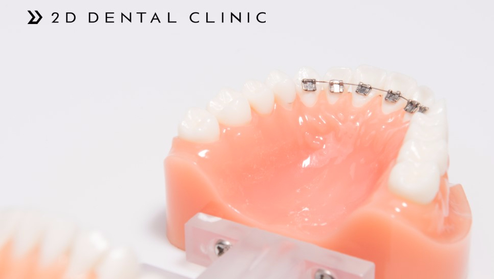 나비치아, 앞니 부분 2D교정으로 교정 기간 단축! 관련 이미지 1