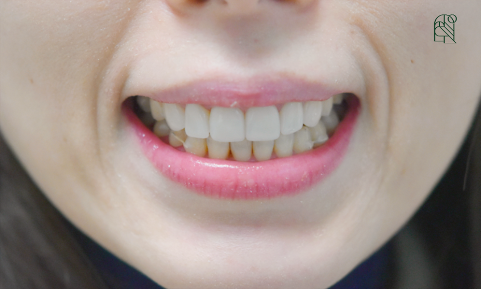 벌어진 앞니, 앞니벌어짐(diastema) 치료 - 레진, 교정, 라미네이트 관련 이미지 9