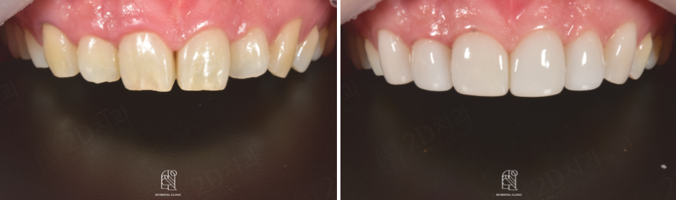 무삭제블랙필름 실제 후기 관련 이미지 9