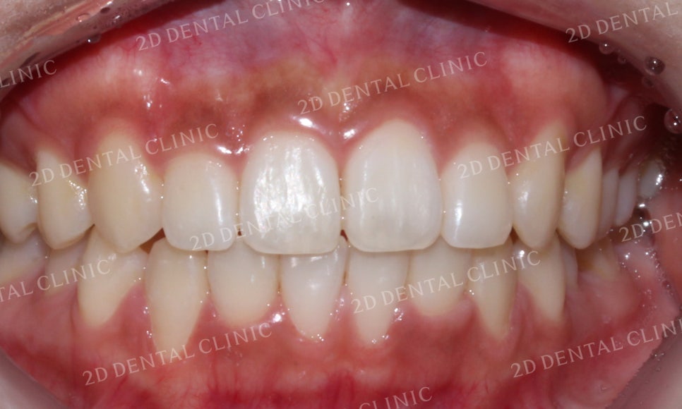 [앞니교정]토끼앞니교정, 부분교정으로 토끼이빨 탈출하기! by.투디치과(2D치과) 관련 이미지 12