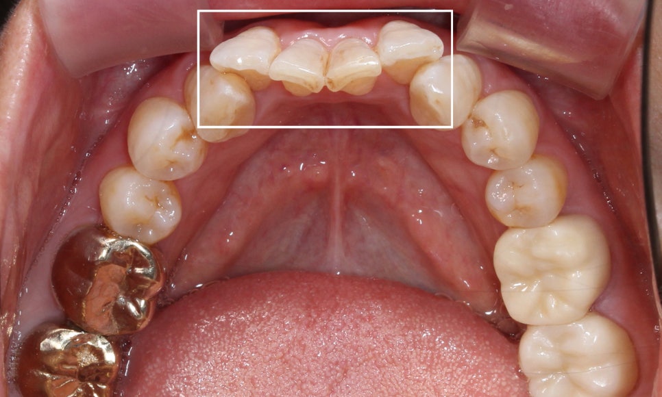 2D교정으로 아랫니 부분교정 빠르게 완성하기! 관련 이미지 1
