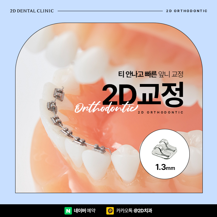 투디교정으로 앞니 모양 개선! 논현역 2D교정 관련 이미지 1