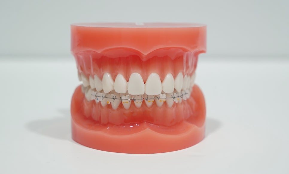 2D(투디)치과!치아교정!클리피씨교정,순측 교정?설측교정? 관련 이미지 2