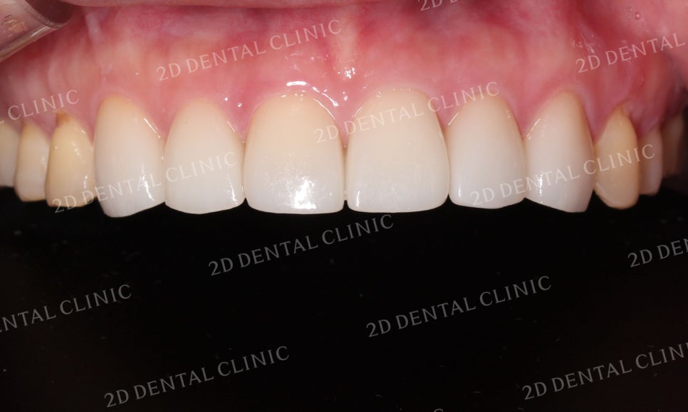누렇고 손상된 치아를 밝고 가지런하게! by. 투디치과(2D치과)_블링스 시술후기 관련 이미지 12