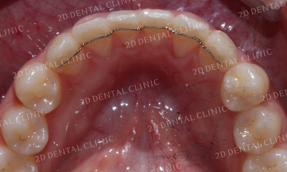 [앞니교정]토끼앞니교정, 부분교정으로 토끼이빨 탈출하기! by.투디치과(2D치과) 관련 이미지 16