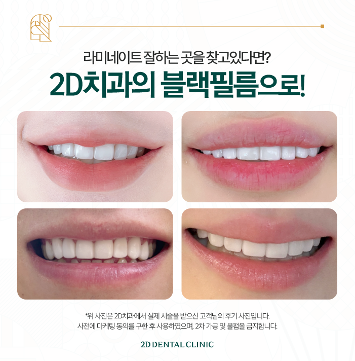 강남라미네이트치과 신논현치과 라미네이트를 고민하고 있다면 관련 이미지 7